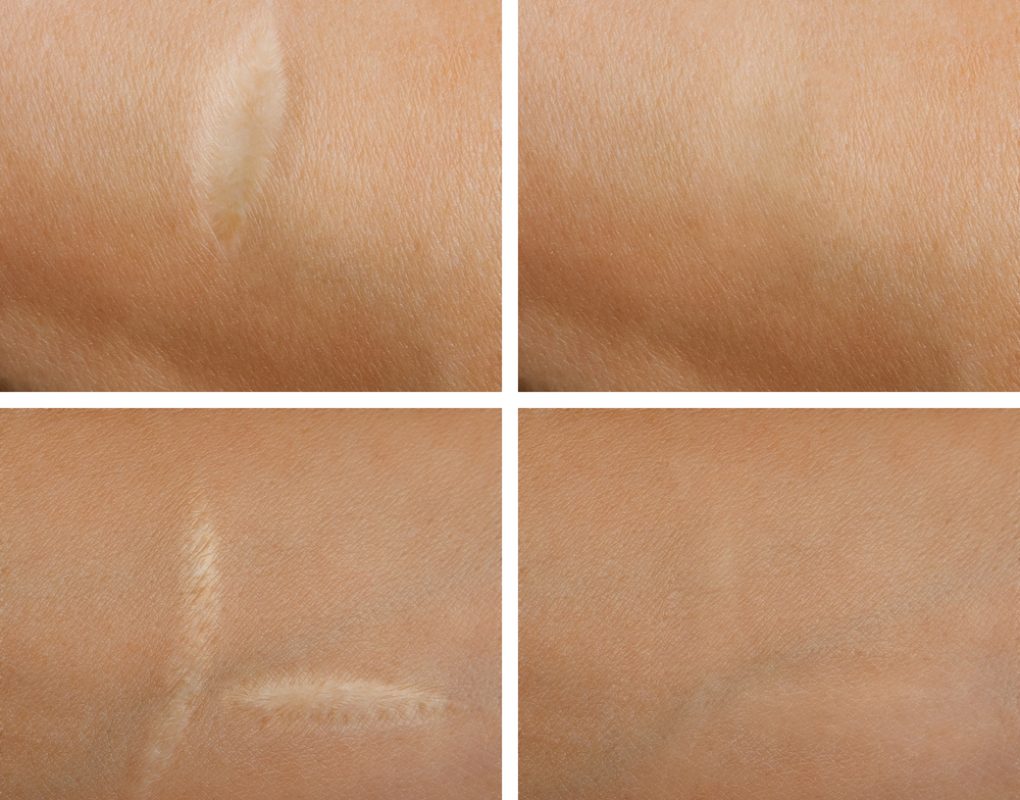 before-after-scar fractional 1